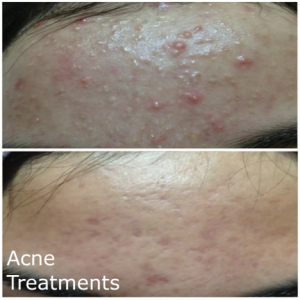 Acne Treatments MBB salon