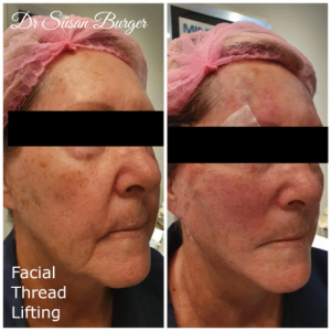 Facial Thread Lifting MBB salon