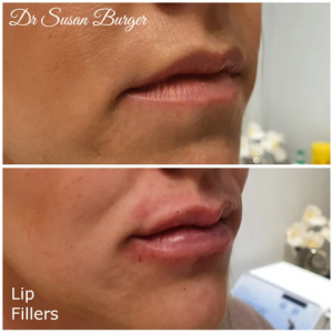 Lip fillers MBB salon