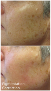 Pigmentation Correction MBB salon