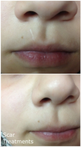 Scar Treatments MBB salon